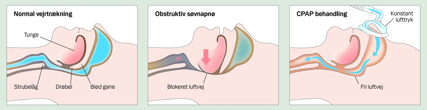Illustration af søvnapnø
